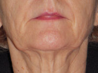 facial flex test