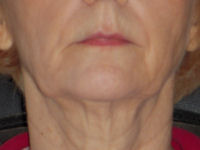 facial flex test