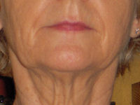 facial flex test