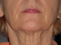 facial flex test